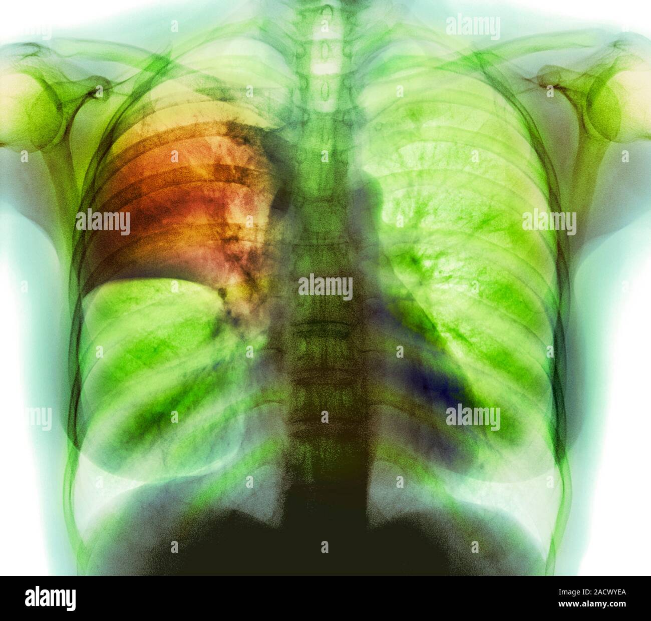 Pulmonary consolidation. Coloured frontal Xray of the lungs of a 54