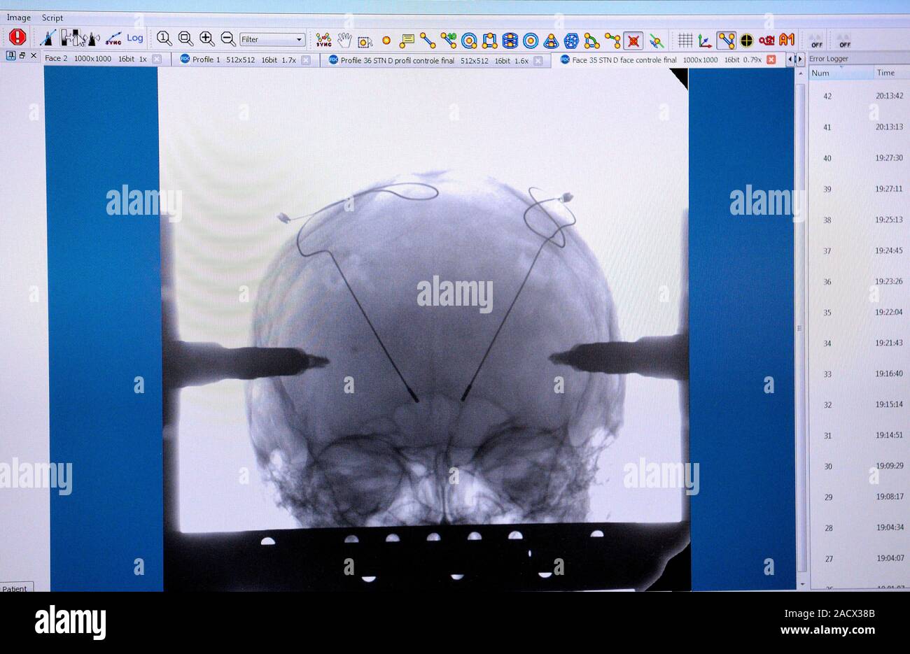 Parkinson's disease brain surgery. Xray during surgery to implant