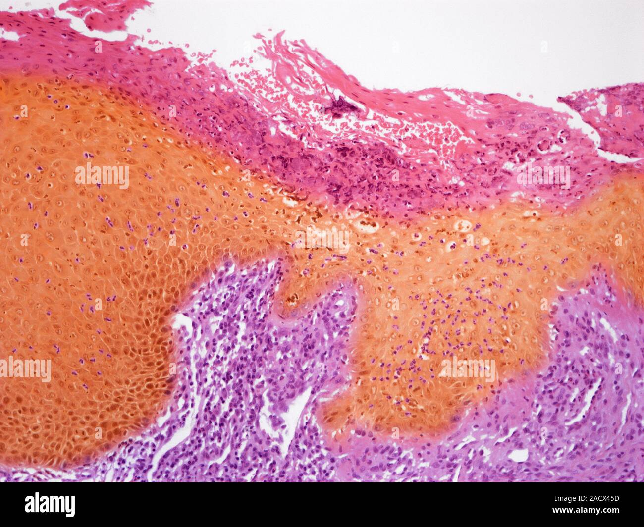 Section of the tongue with thrush, light micrograph. Oral thrush is a ...