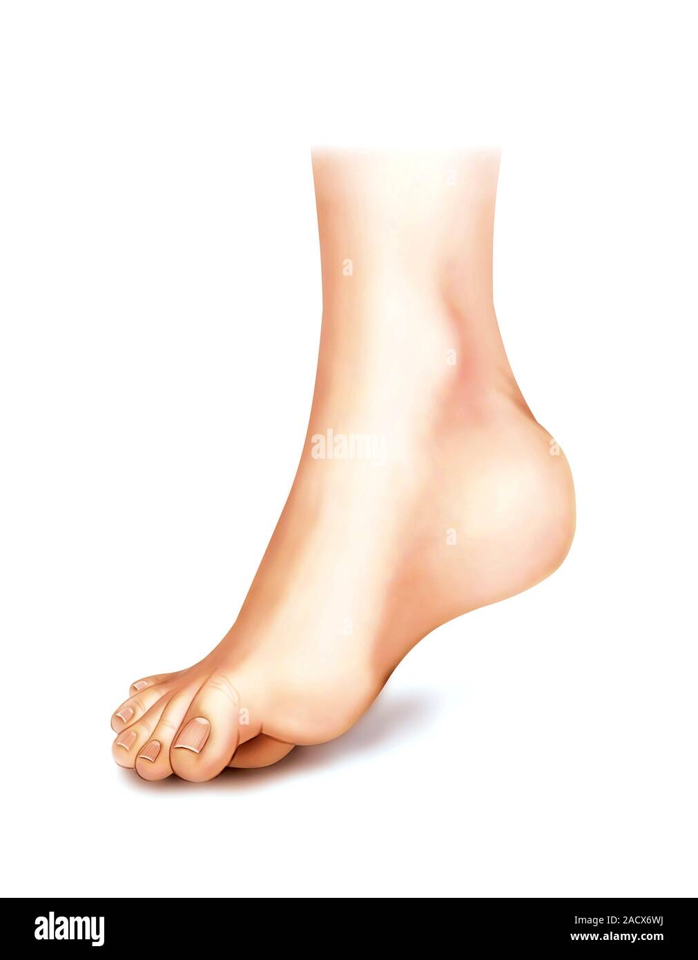 Illustration of the talipes or foot deformations from the anatomical ...