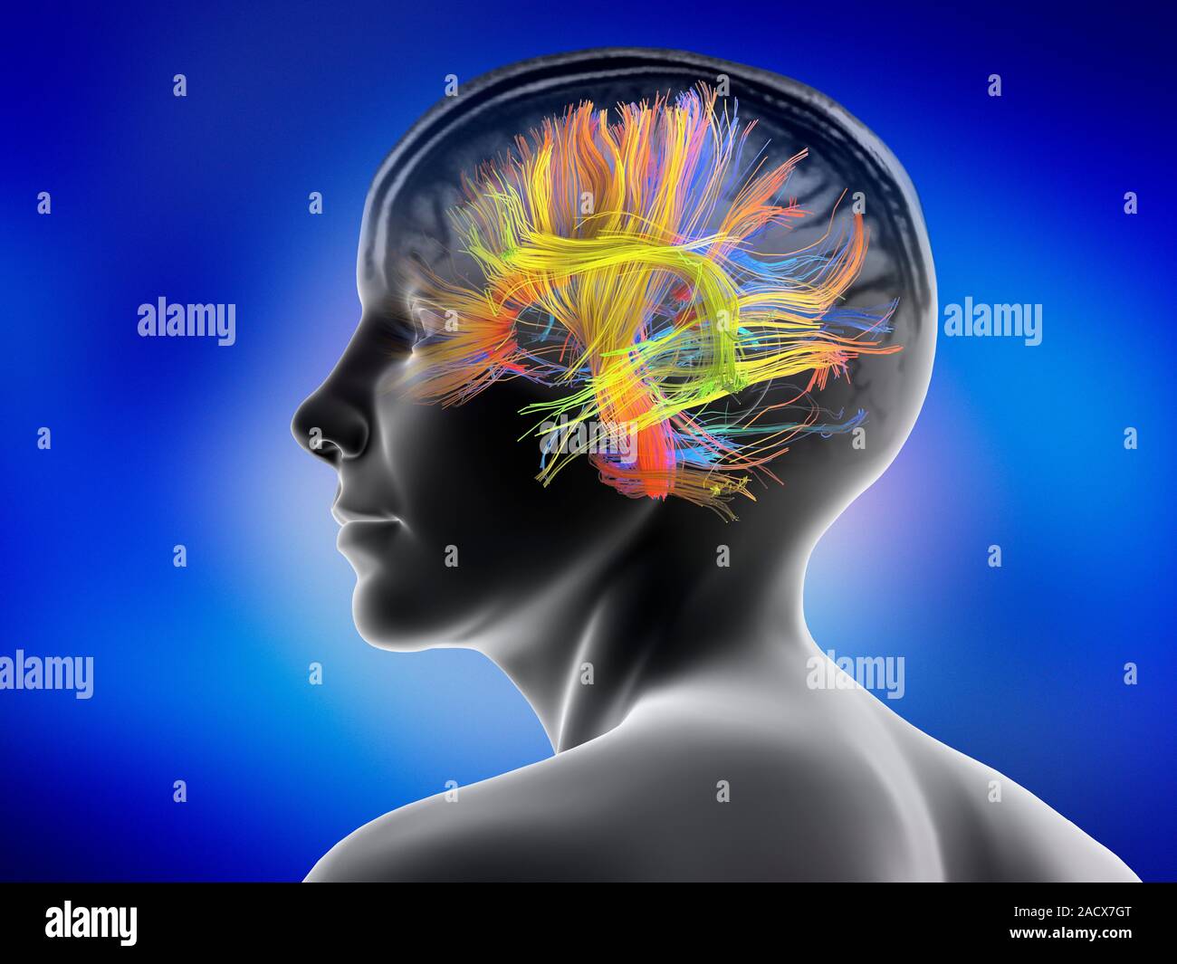 White matter fibres overlaid a mri scan and a female head. Coloured 3D ...