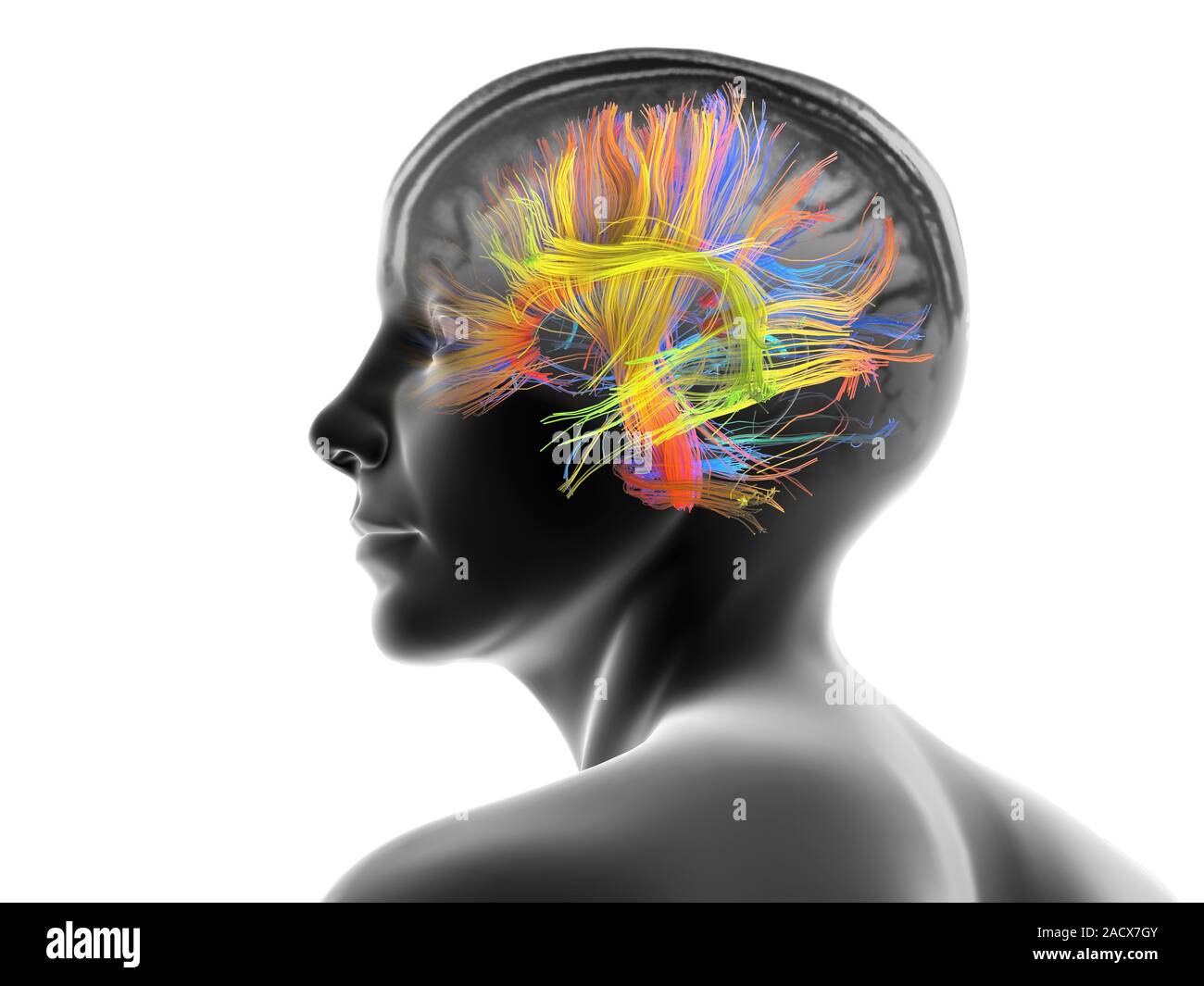 White matter fibres overlaid a mri scan and a female head. Coloured 3D ...