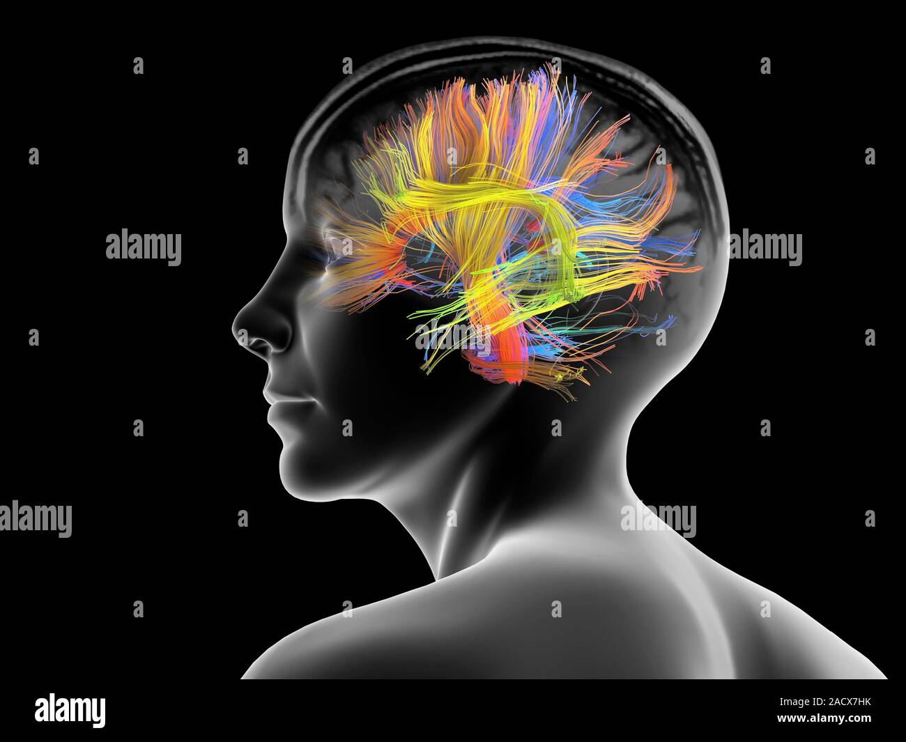 White matter fibres overlaid a mri scan and a female head. Coloured 3D ...