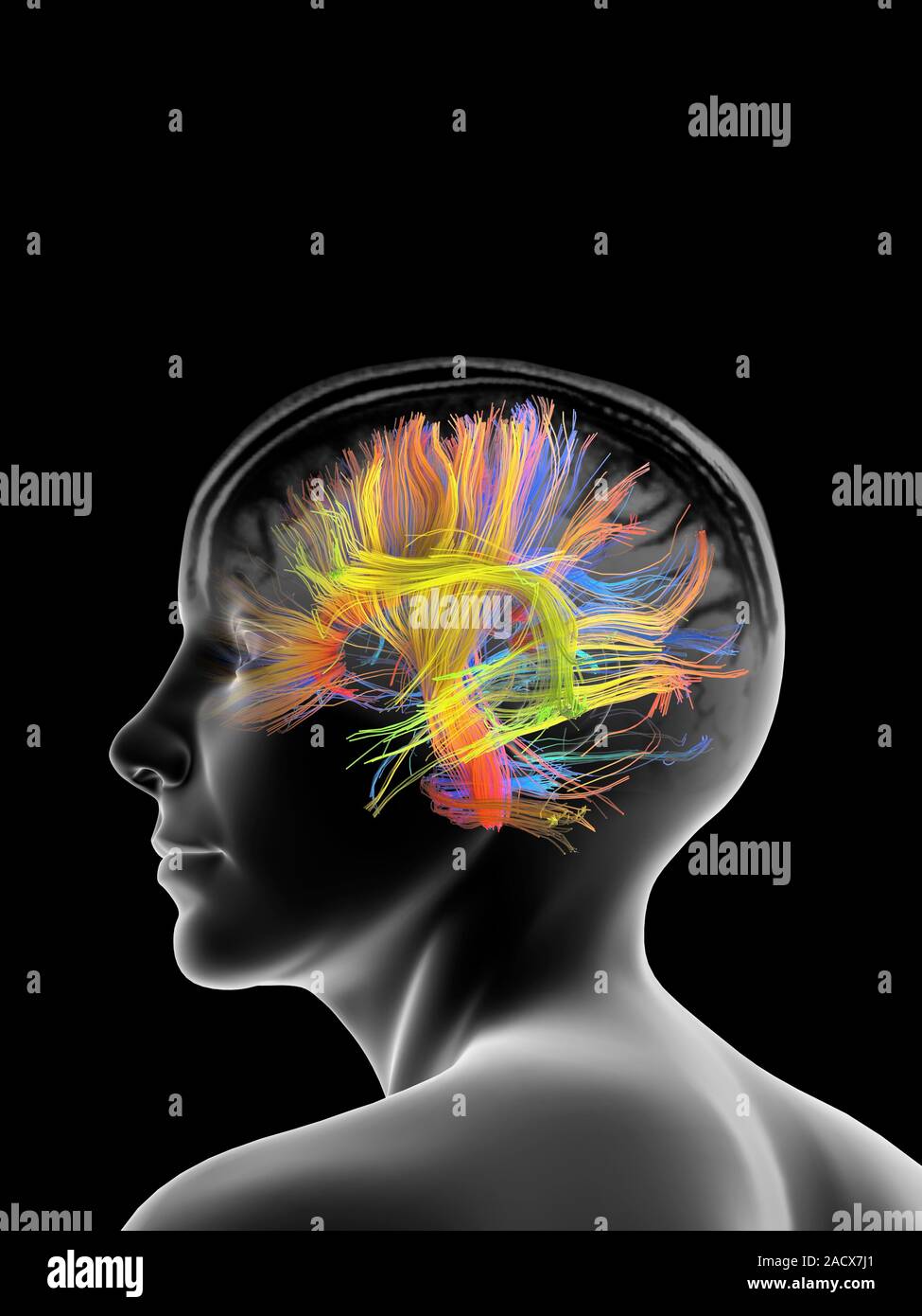 White matter fibres overlaid a mri scan and a female head. Coloured 3D ...