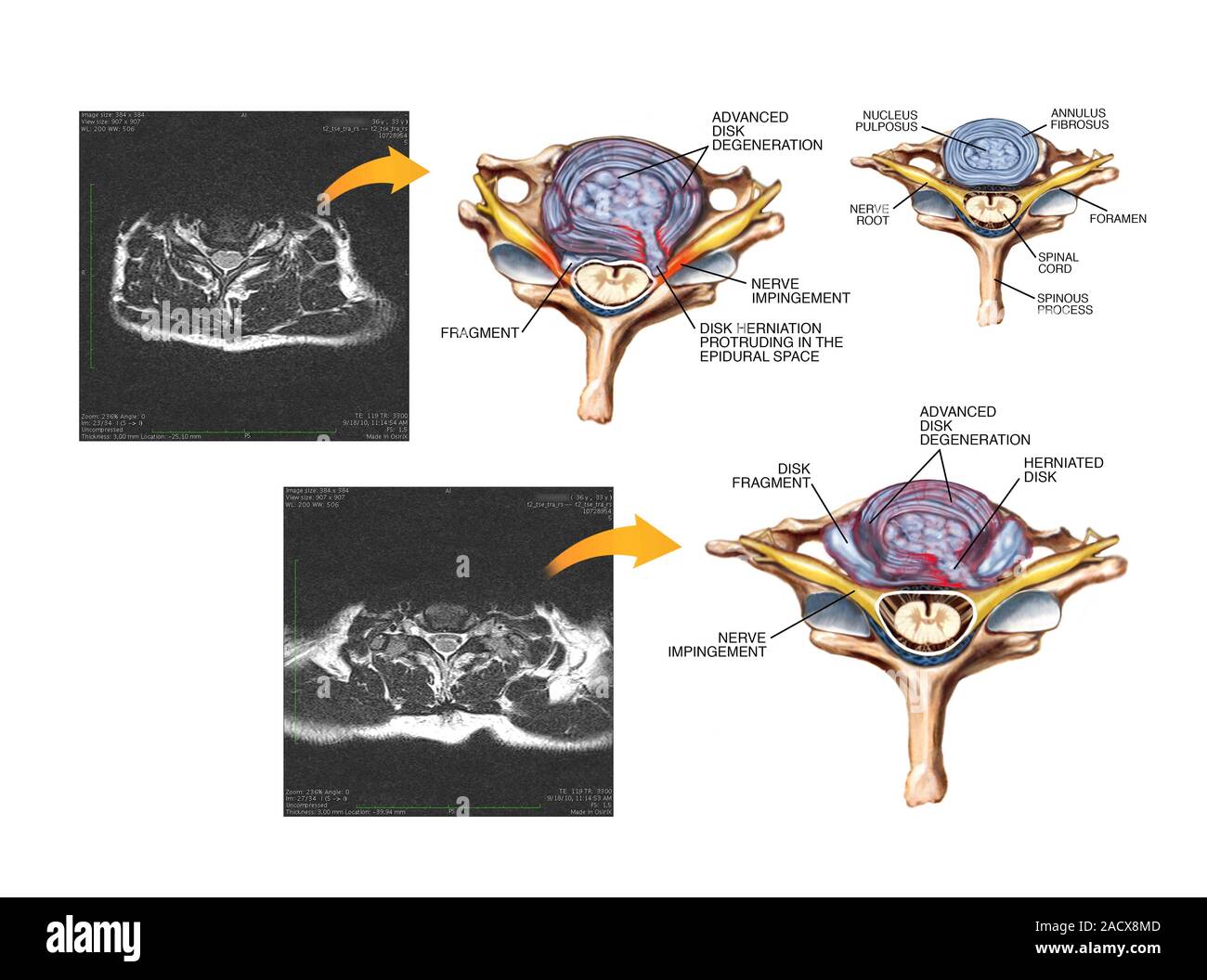 Slipped discs in the cervical spine. Labelled artworks and