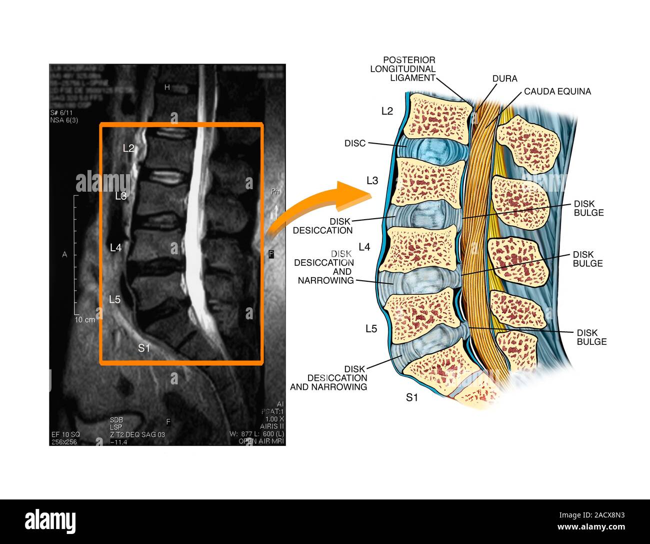 Bulging discs in the lumbar spine. Labelled artwork and corresponding