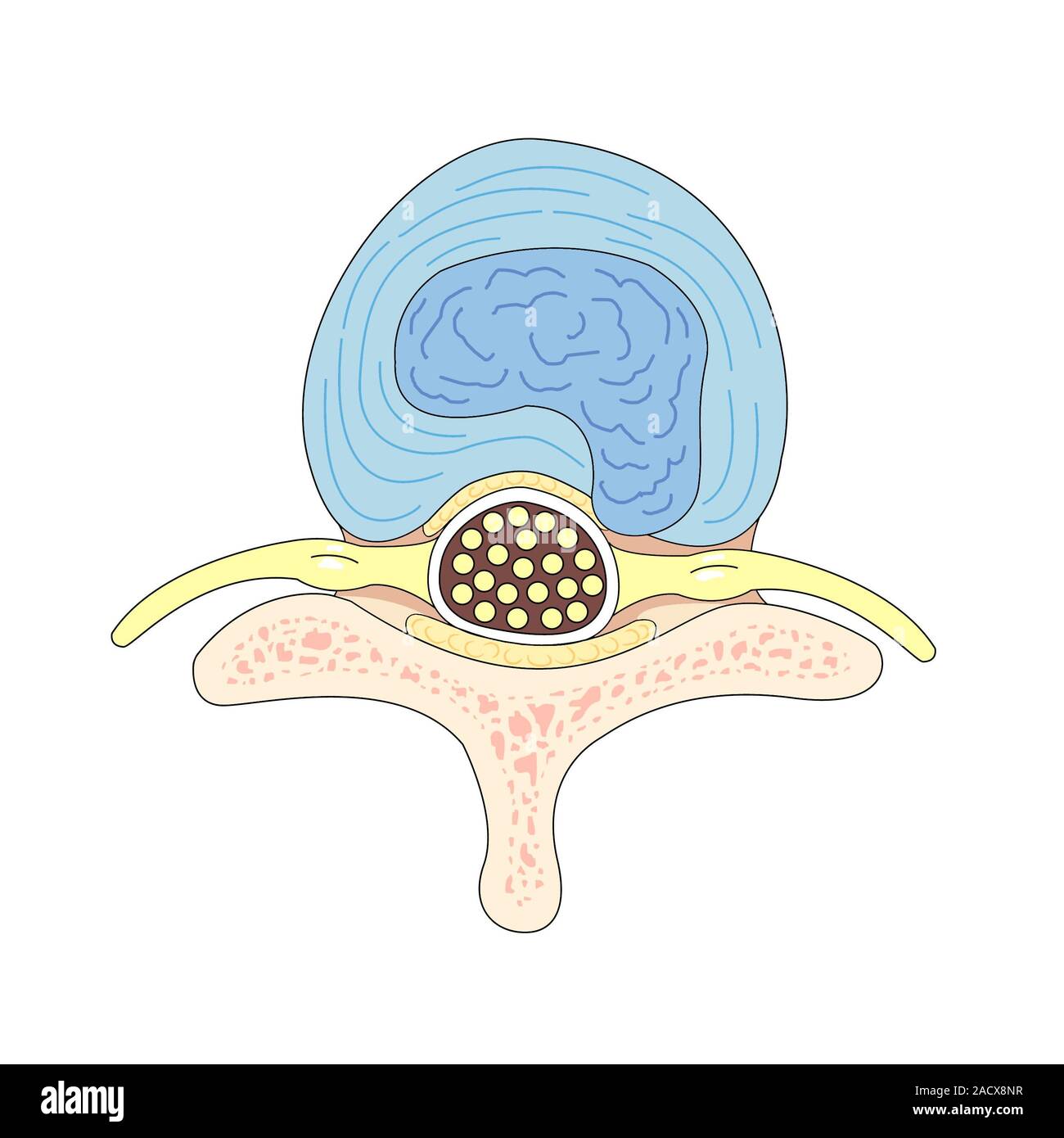 Herniated intervertebral disc. Artwork of an axial view of a slipped