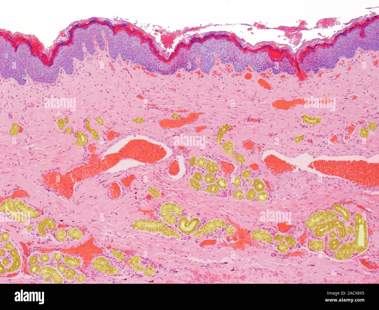Myelomeningocele sac, light microscopy of the outer wall of the sac