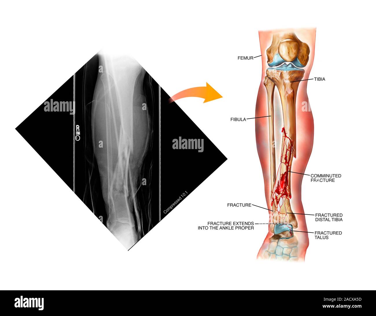 Comminuted fracture of the tibia. Labelled artwork and corresponding X