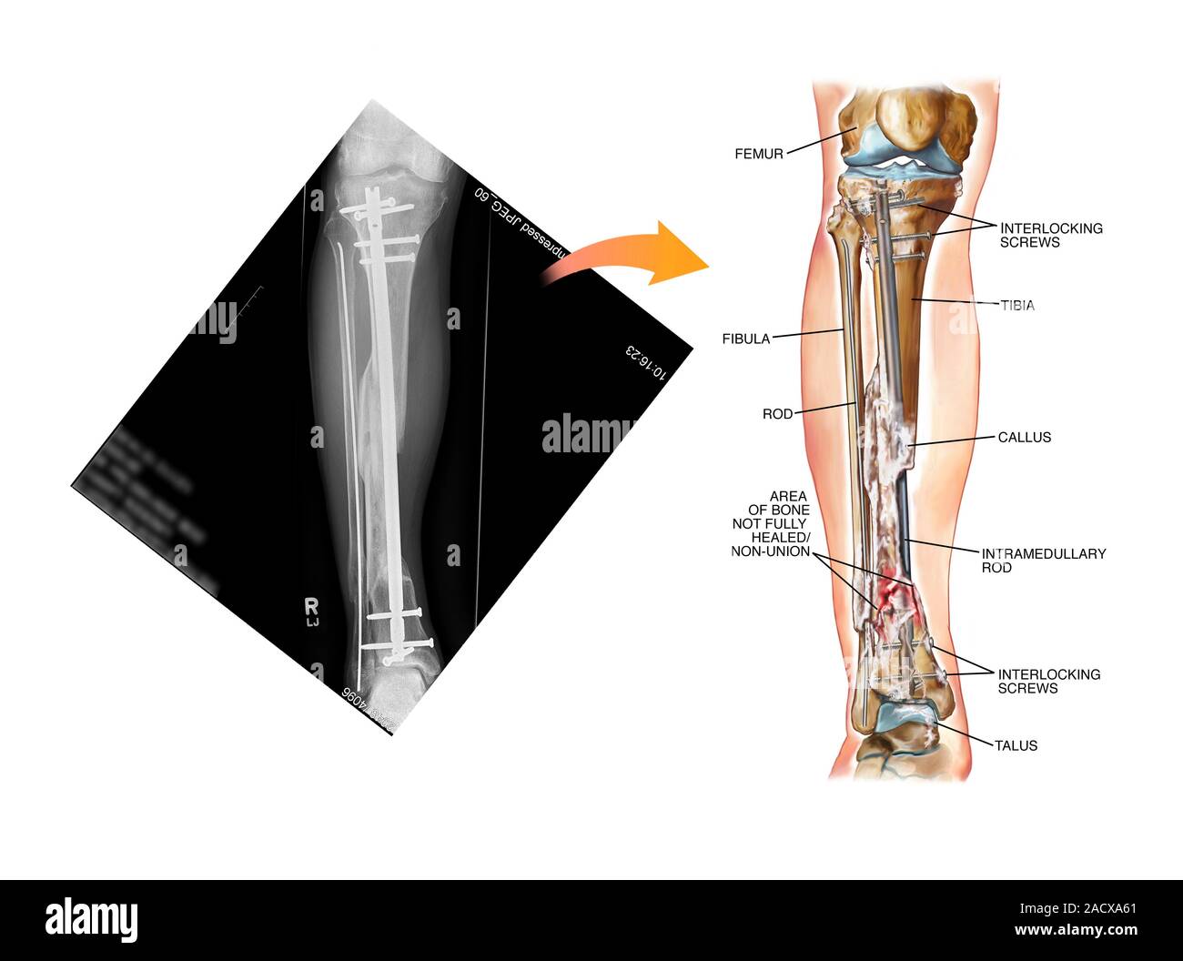 Internal fixation of lower leg bones. Labelled artwork and