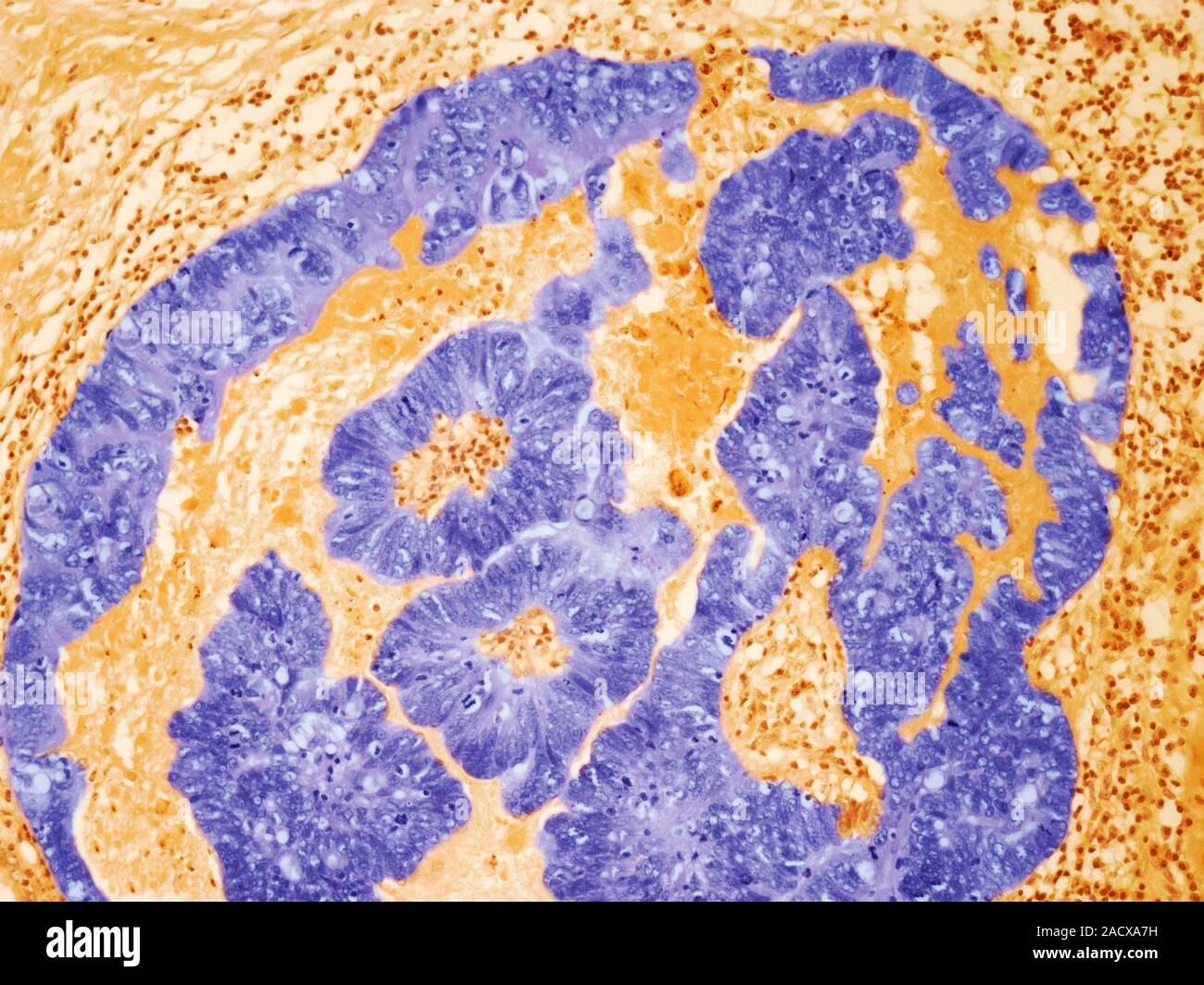 Umbilical adenoma, light micrograph. An umbilical adenoma (raspberry