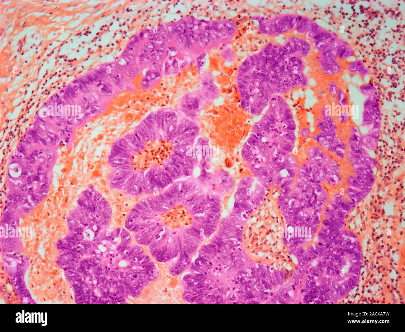 Umbilical adenoma, light micrograph. An umbilical adenoma (raspberry