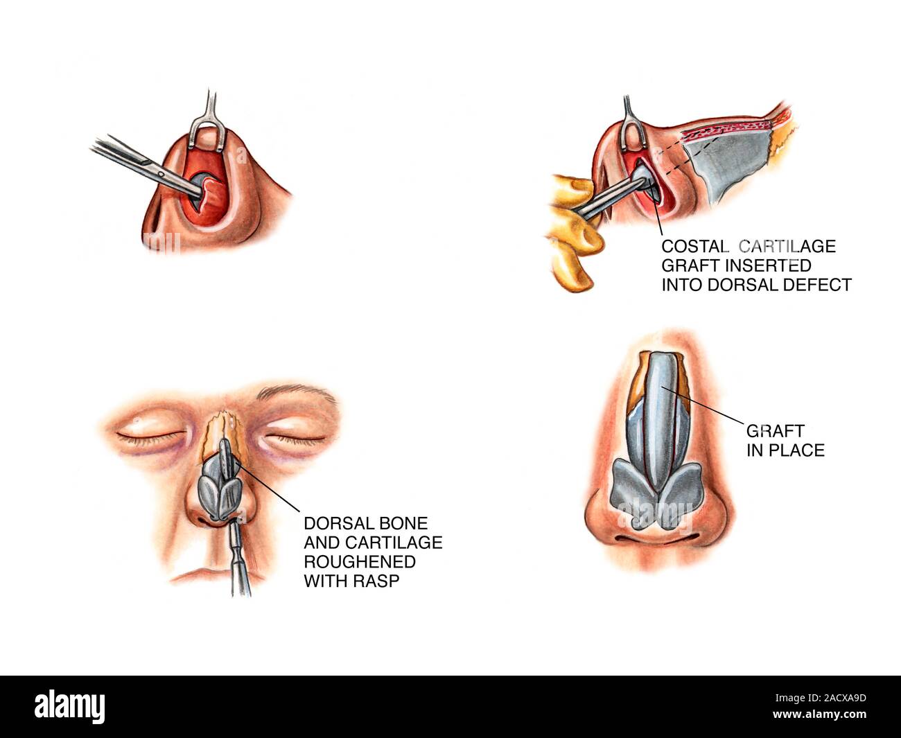 Complete Transfixation Rhinoplasty Rhinoplasty surgery to reconstruct nose. Sequence of artworks ...