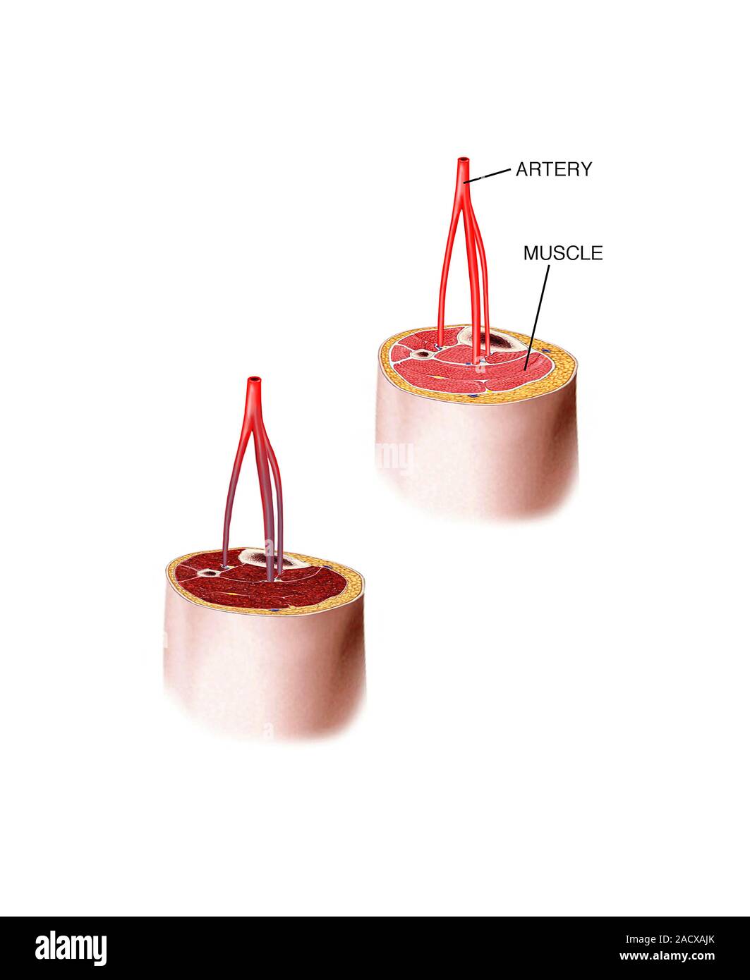 Compartment syndrome, artwork. This syndrome is a lifethreatening