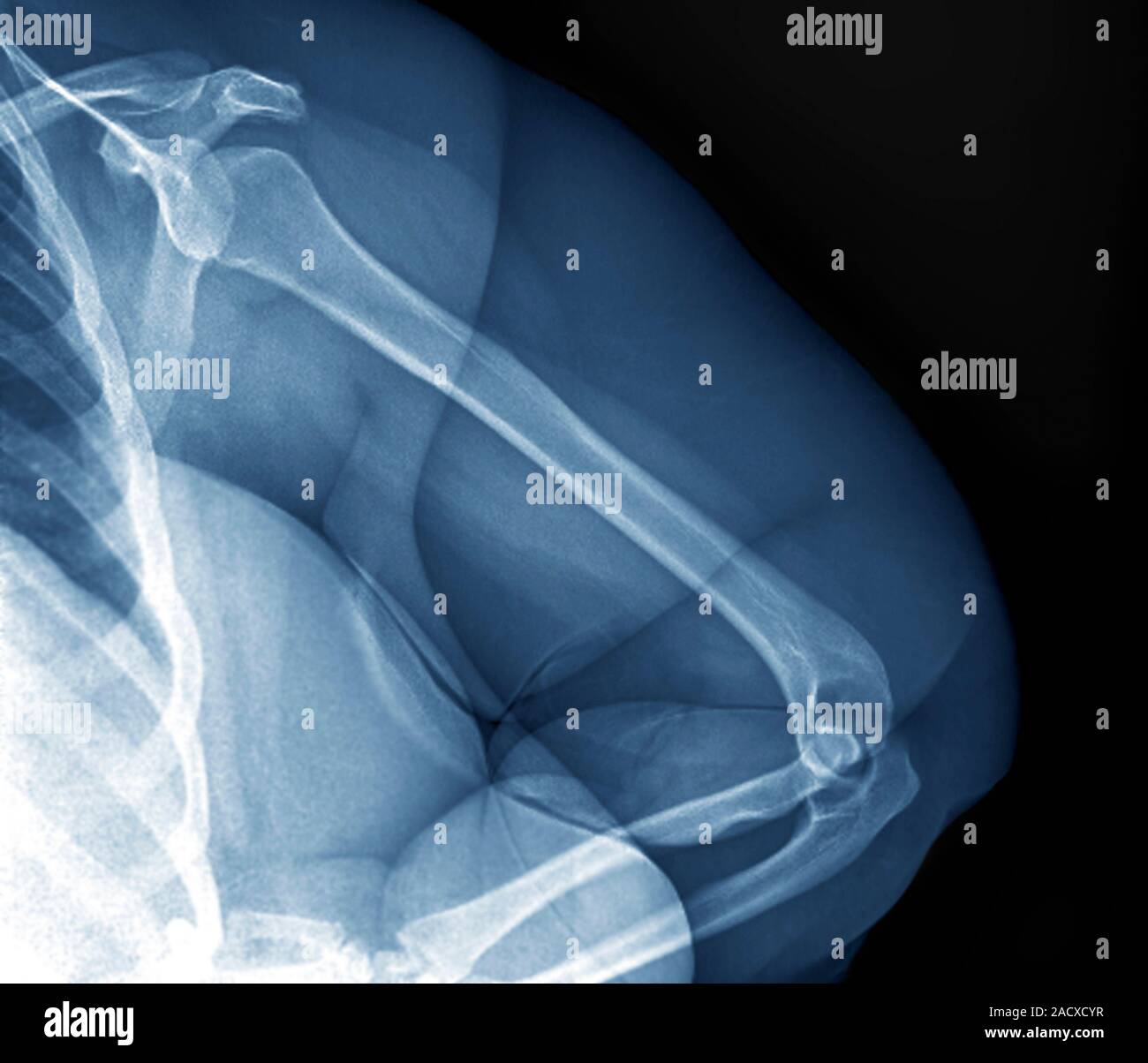 Coloured x-ray of the left arm (anterior view) of an obese 23 year-old ...