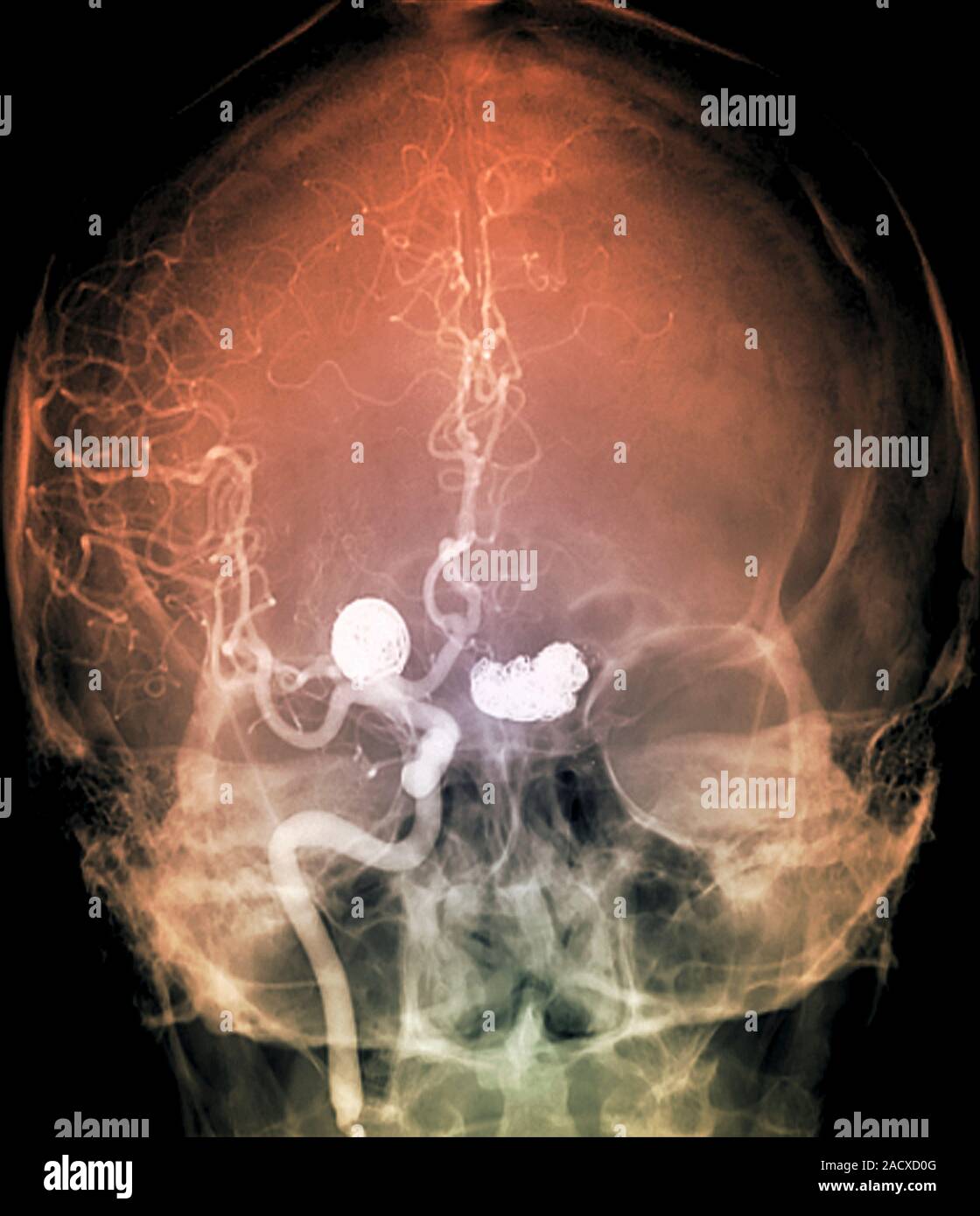 Coloured angiogram (blood vessel X-ray, frontal view) of the head of a ...