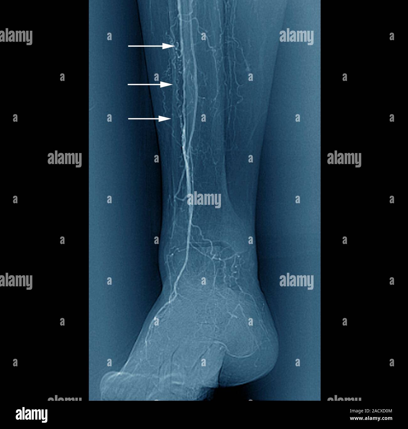 Coloured angiogram (blood vessel Xray) of a 72 yearold woman's right