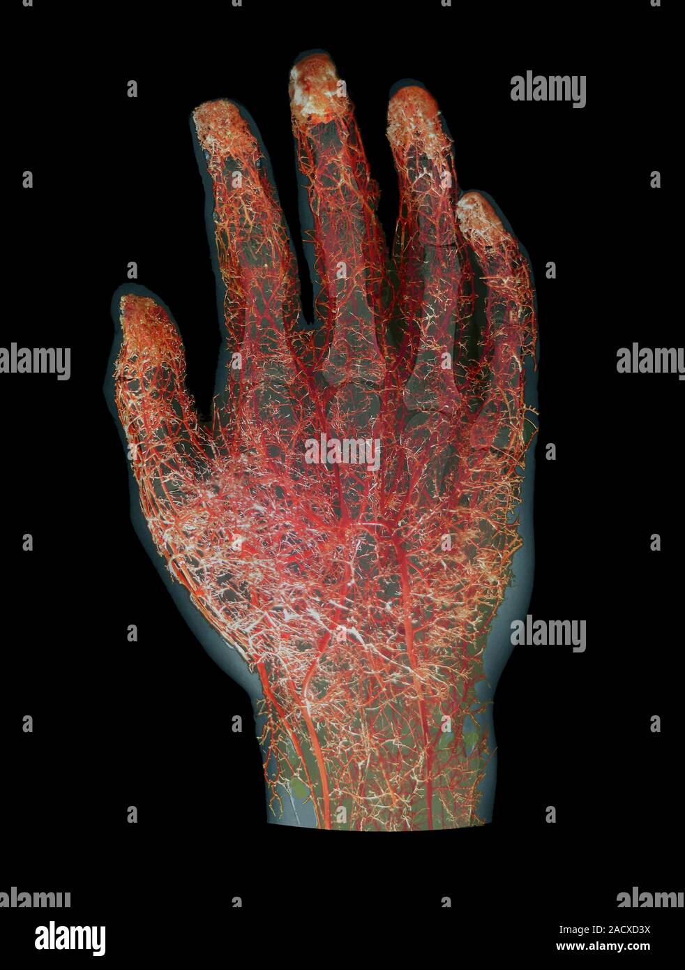 Plastic corrosion cast of the blood vessels of the human hand