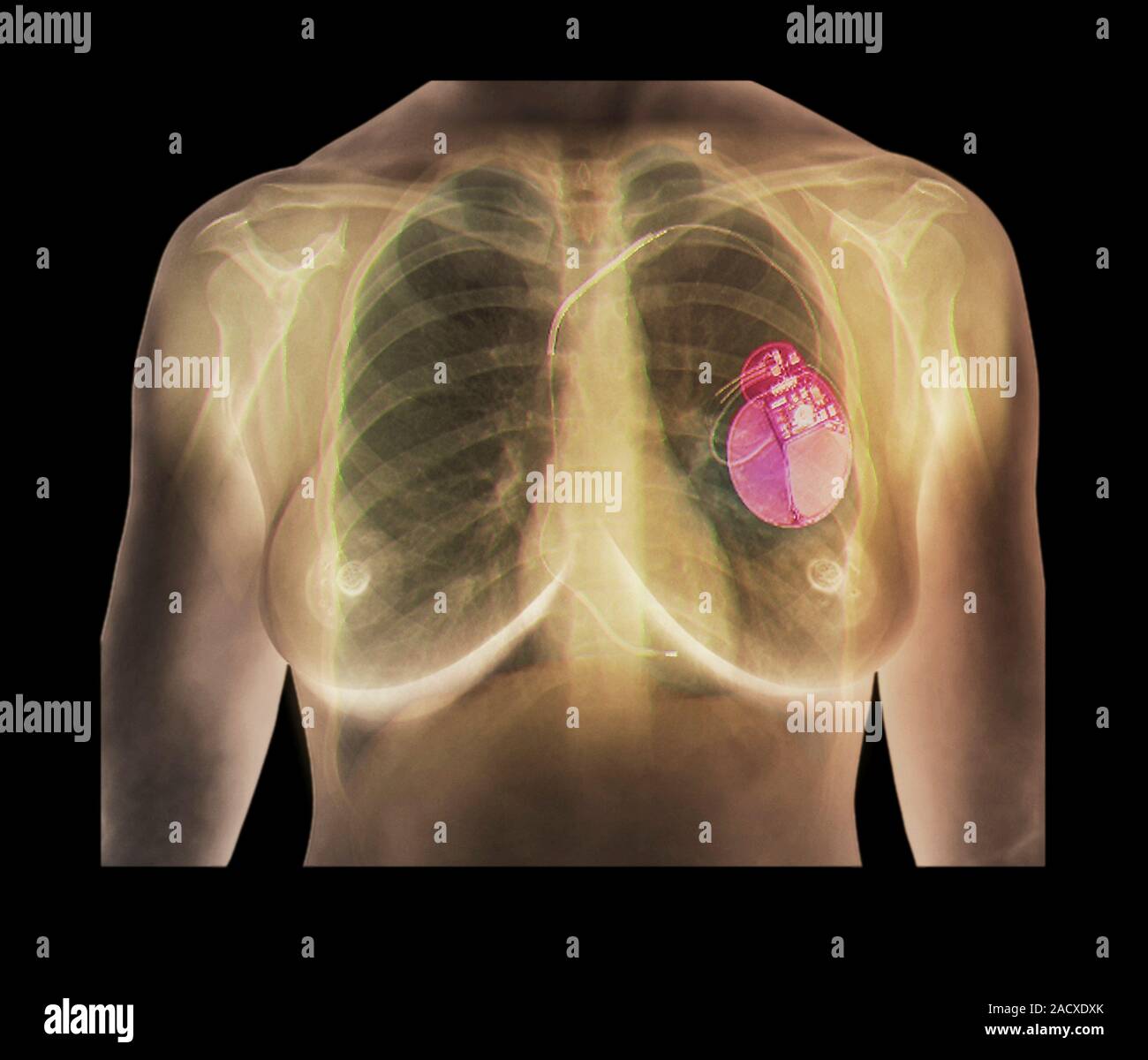 Woman With Pacemaker Pacemaker. Coloured frontal X-ray of a 24 year old woman's chest. A ...