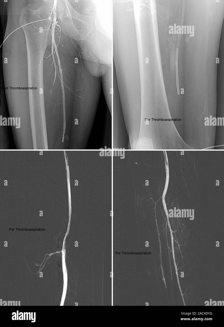 Thrombus (blood clot) in leg. Angiograms (blood vessel Xrays) of the