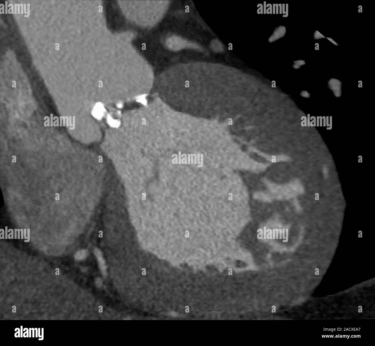 Heart valve disease. Computed tomography (CT) scan of a 68 year old