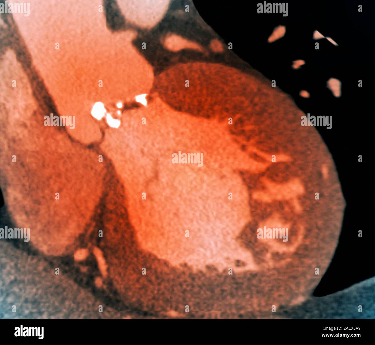 Heart valve disease. Coloured computed tomography (CT) scan of a 68