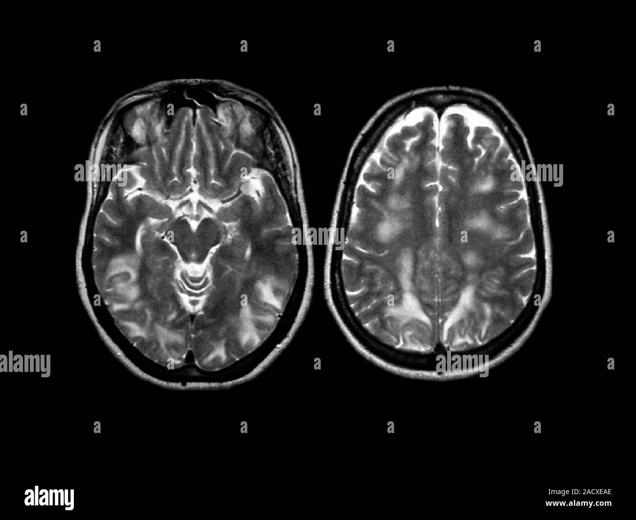 Eclampsia. resonance imaging (MRI) scan of the brain of a 27 year old woman (from below