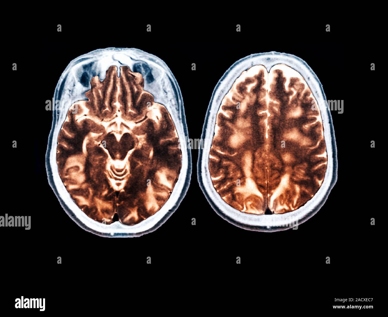 Eclampsia. Coloured resonance imaging (MRI) scan of the brain of a 27 year old woman