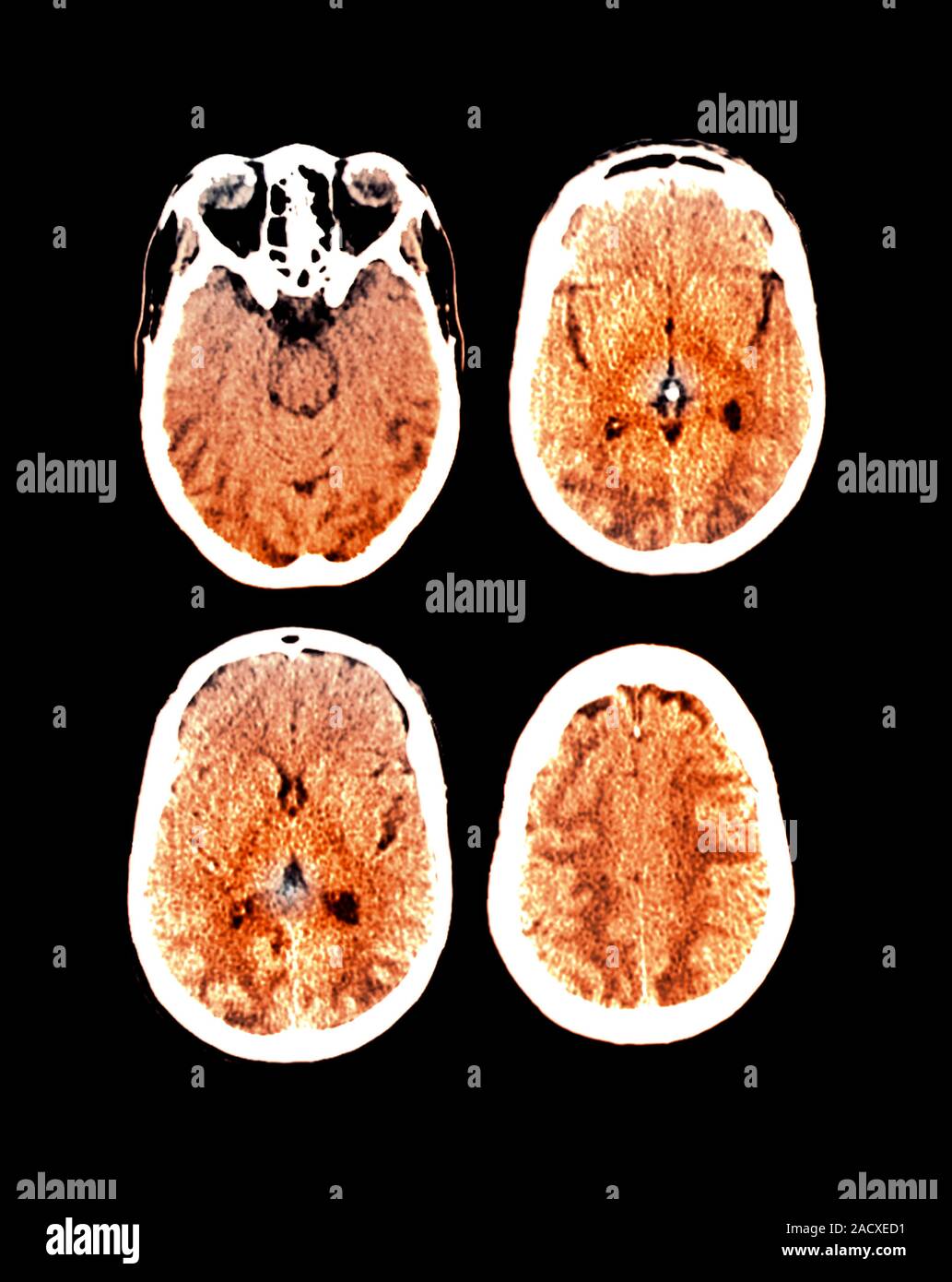 Eclampsia. resonance imaging (MRI) scan of the brain of a 27 year old woman (from below