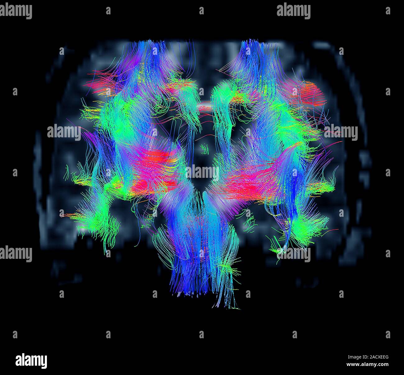 White matter fibres. Coloured diffusion tensor imaging (DTI) scan of ...