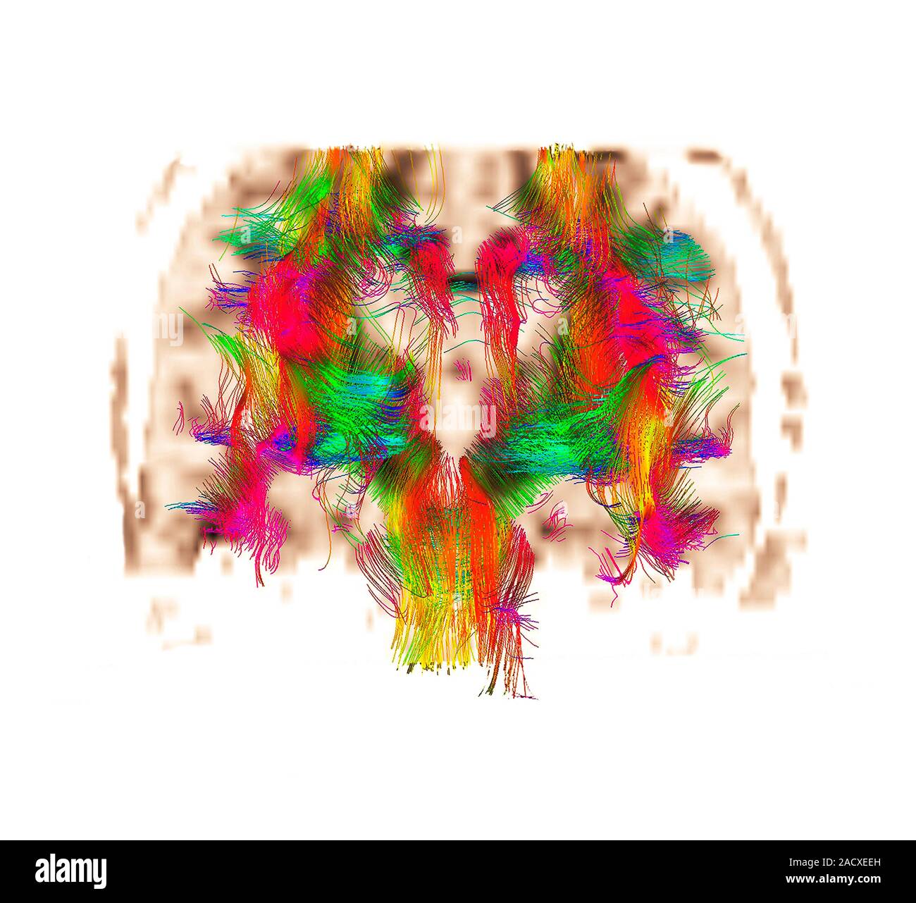 White matter fibres. Coloured diffusion tensor imaging (DTI) scan of ...