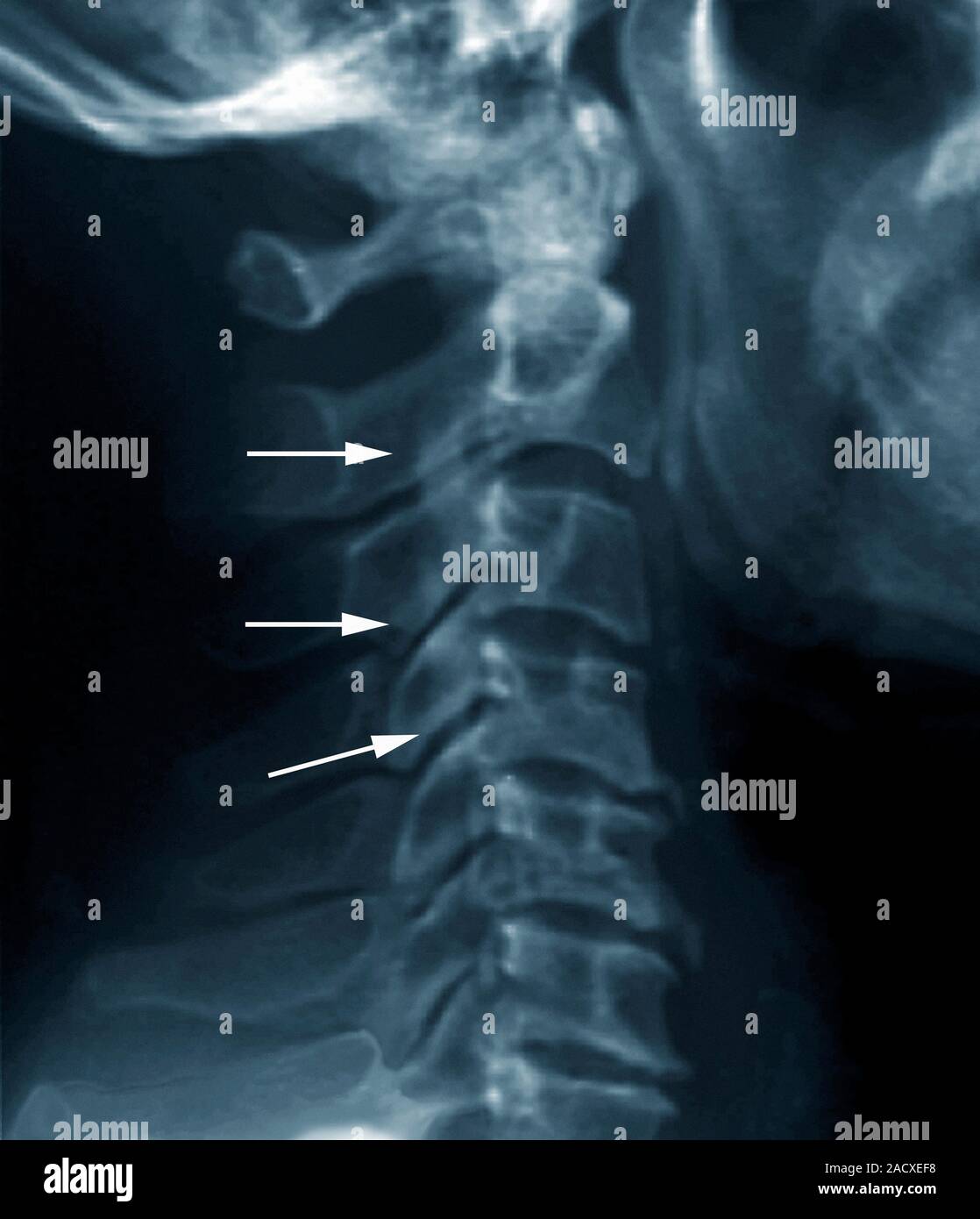 Forestier disease, also known as diffuse idiopathic skeletal