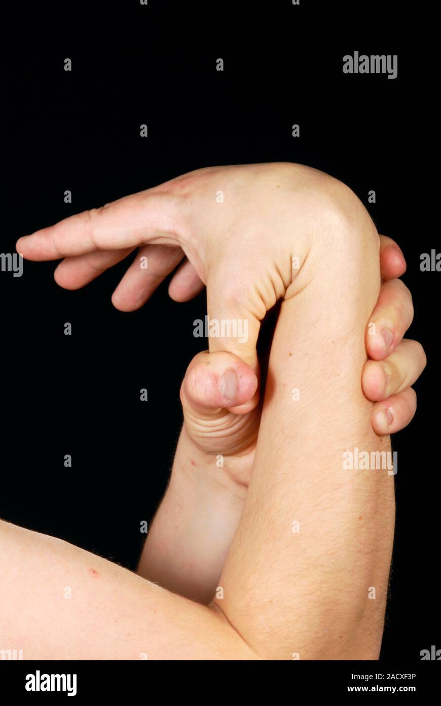 Pseudoxanthoma elasticum. Hand of a patient with pseudoxanthoma elasticum (PXE). This disease, also known as Gronblad-Strandberg Syndrome, is an autos Stock Photo