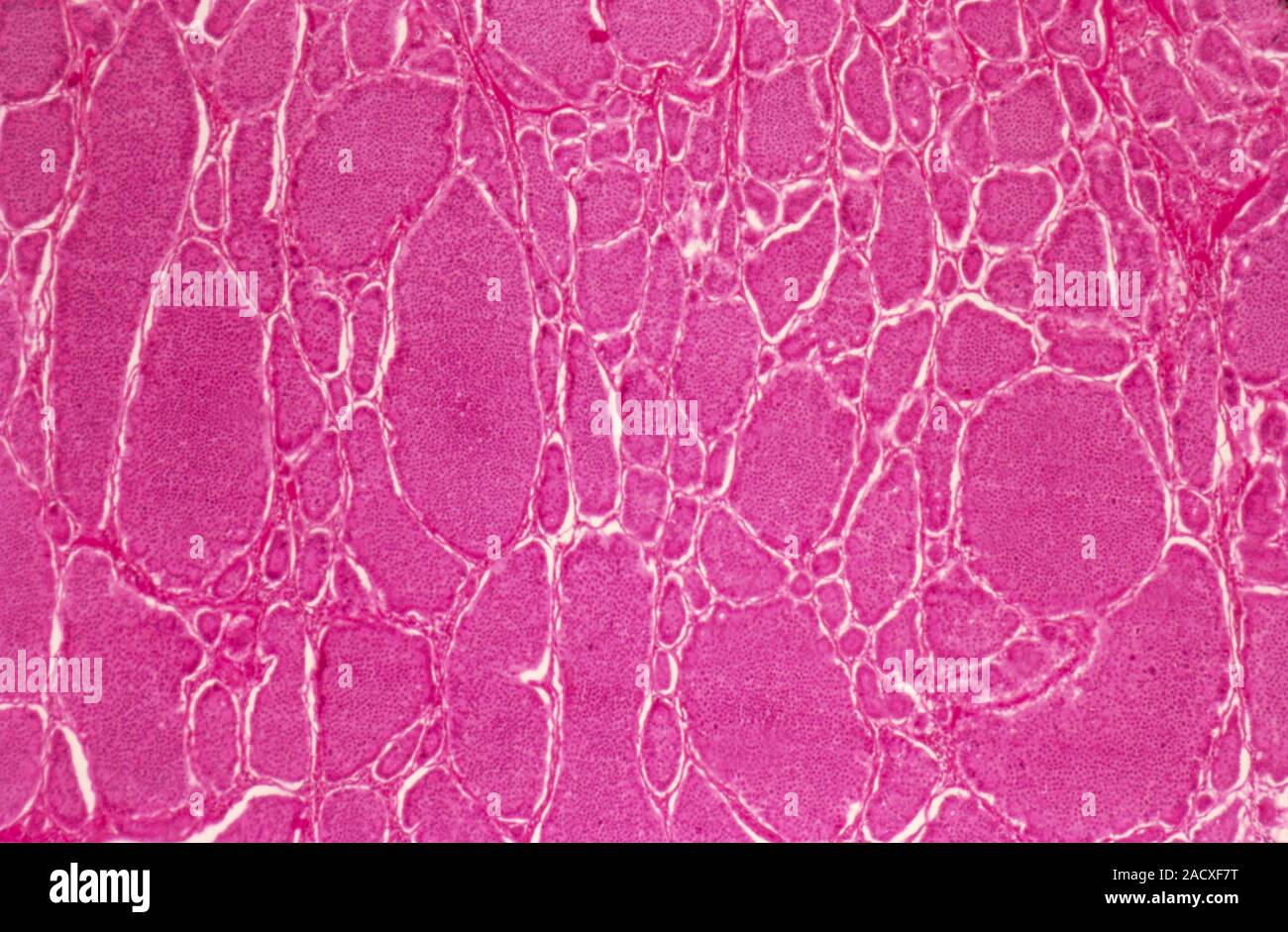 Intestinal cancer, light micrograph. This is a section of a malignant