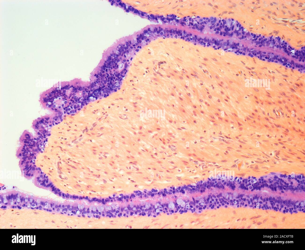 Testicular cancer, light micrograph of a section of a testicular