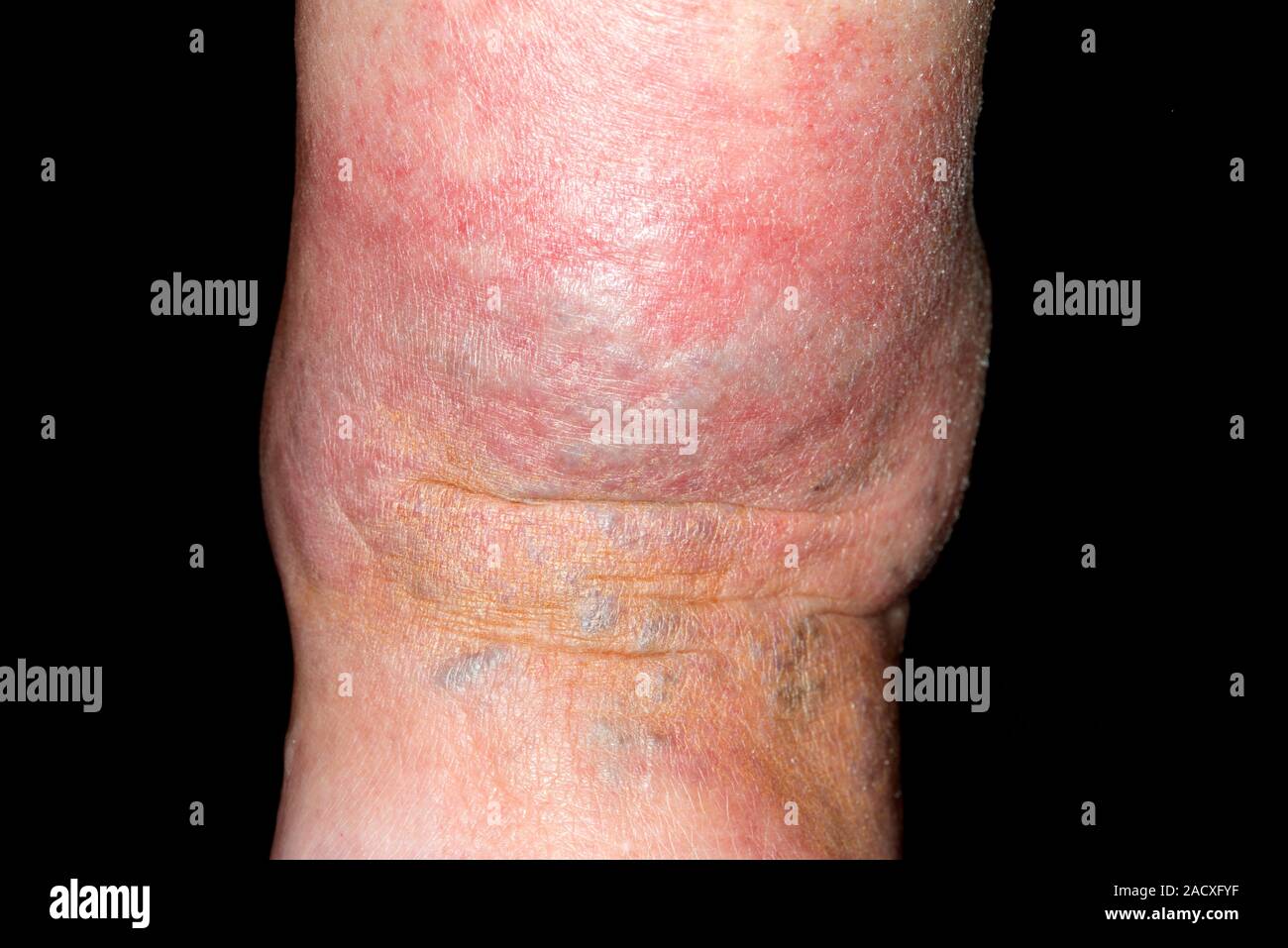 Close-up of the ankle of a 77 year old woman with the skin infection ...