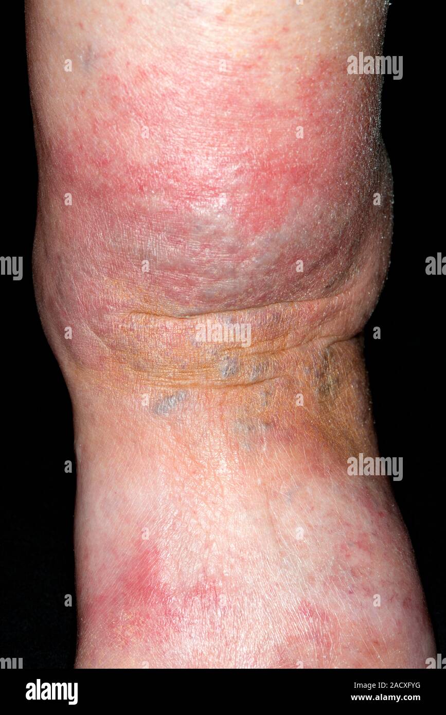 Close-up of the ankle of a 77 year old woman with the skin infection ...