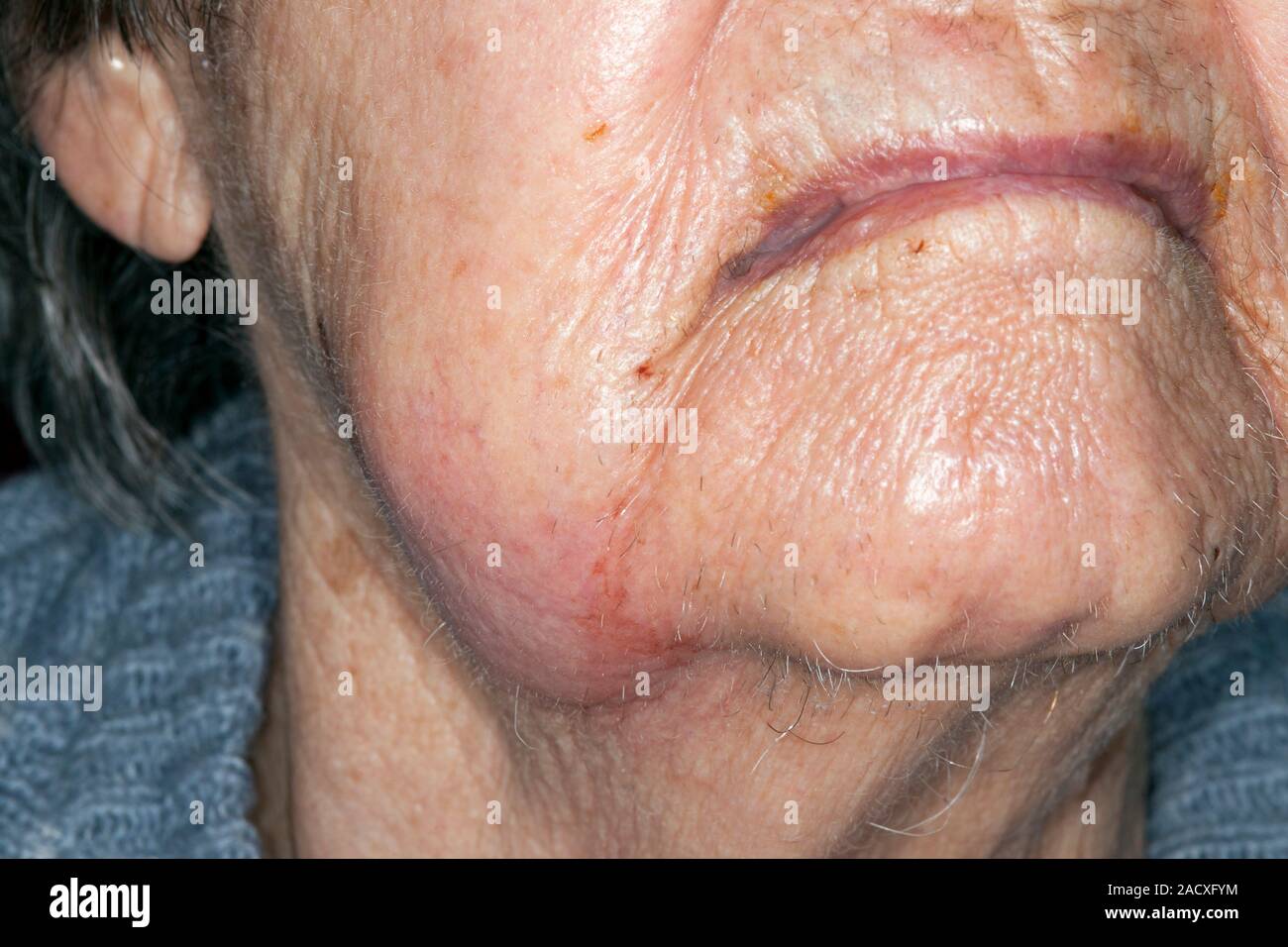 Swelling around the lower jaw of an 86 year old female patient due to a dental abscess. A dental