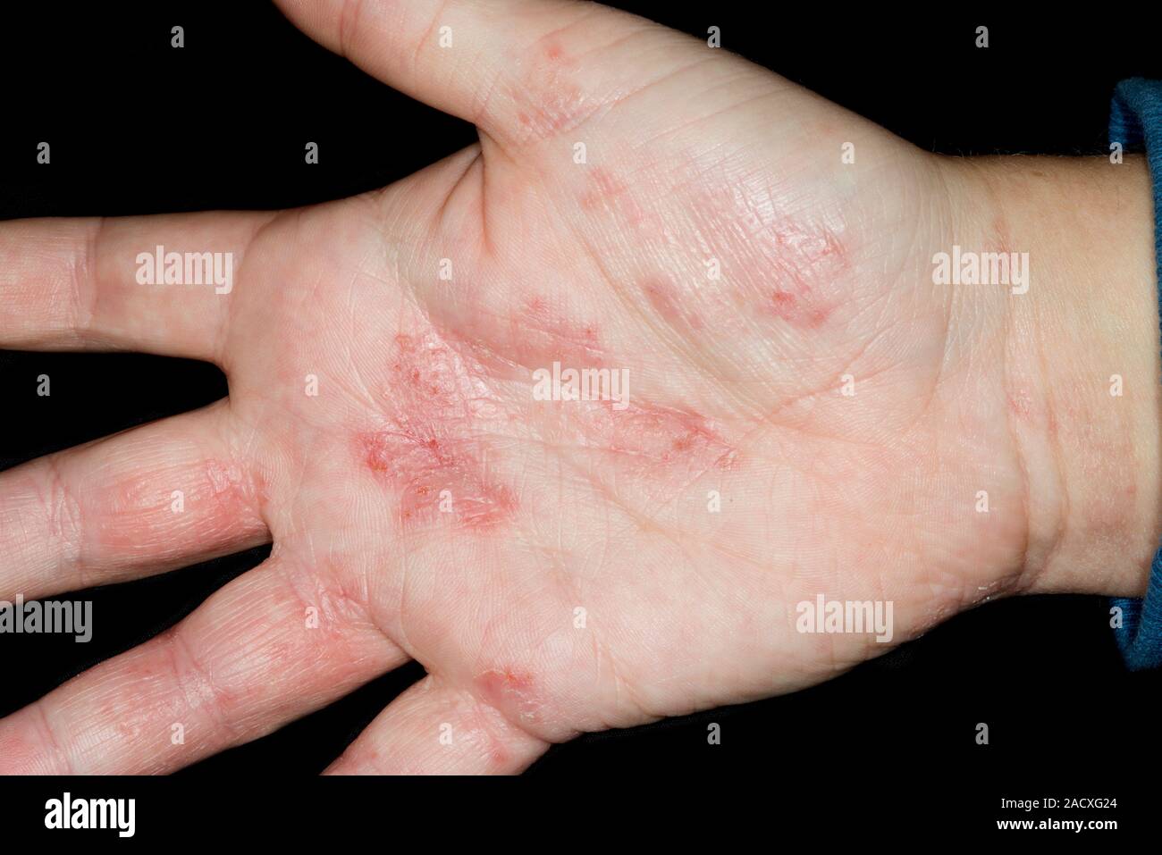 Mild pompholyx, a form of eczema, on the palm of the hand a 22 year old