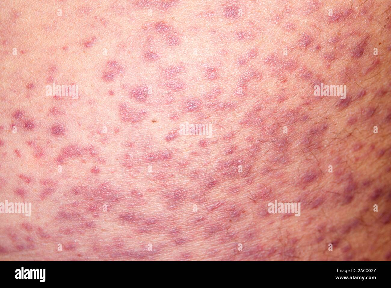 Close up of a rash on the skin of a 52 year old man due to an allergic