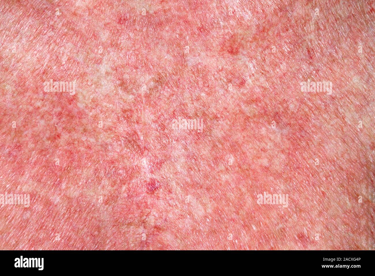 Closeup of exfoliative dermatitis (ED) on the skin of a 63 year old
