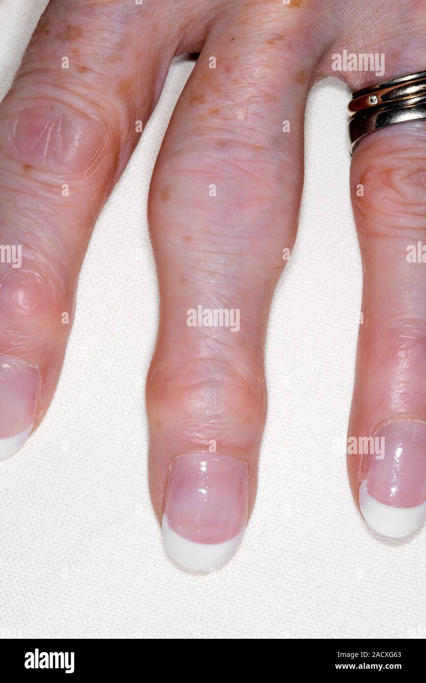 Heberden's nodes on fingers. A 68 year old woman's hand affected by