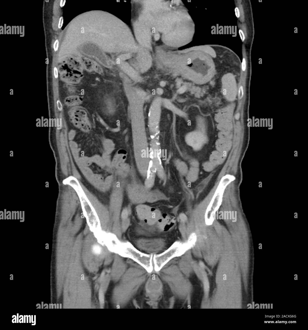 Computed tomography (CT) scan of the abdomen of a 76 year old male ...