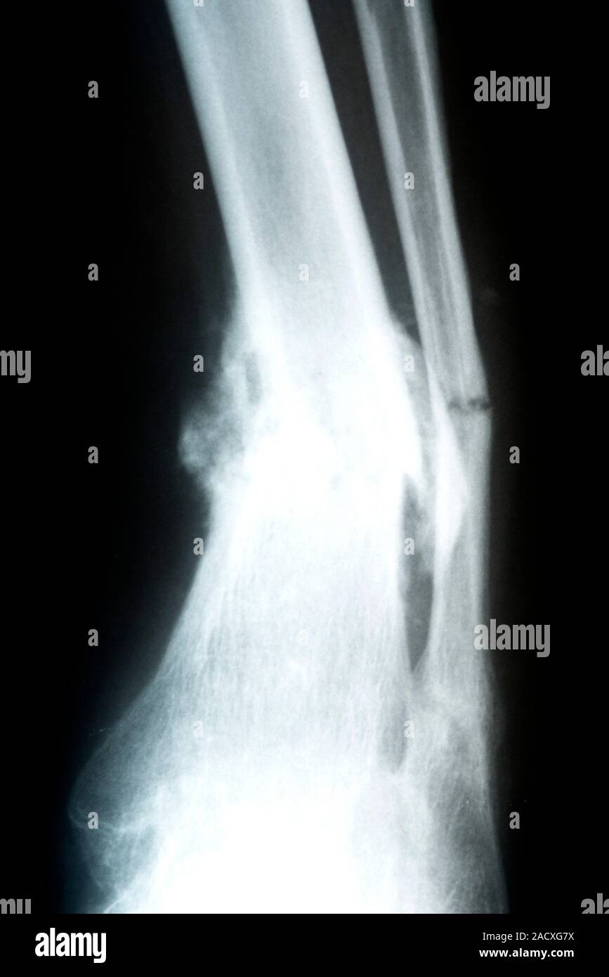 X-ray of fractured tibia (left) and fibula (right) in the leg of a 40 ...
