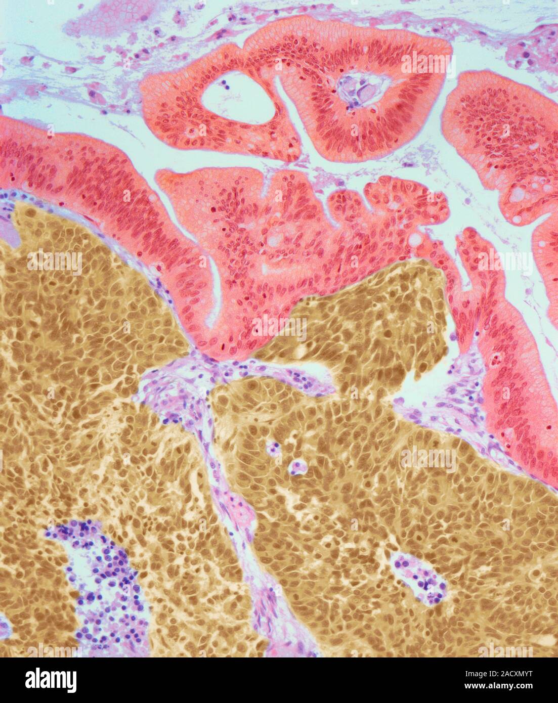 Cervical cancer. Light micrograph (LM) of a section of a large cell