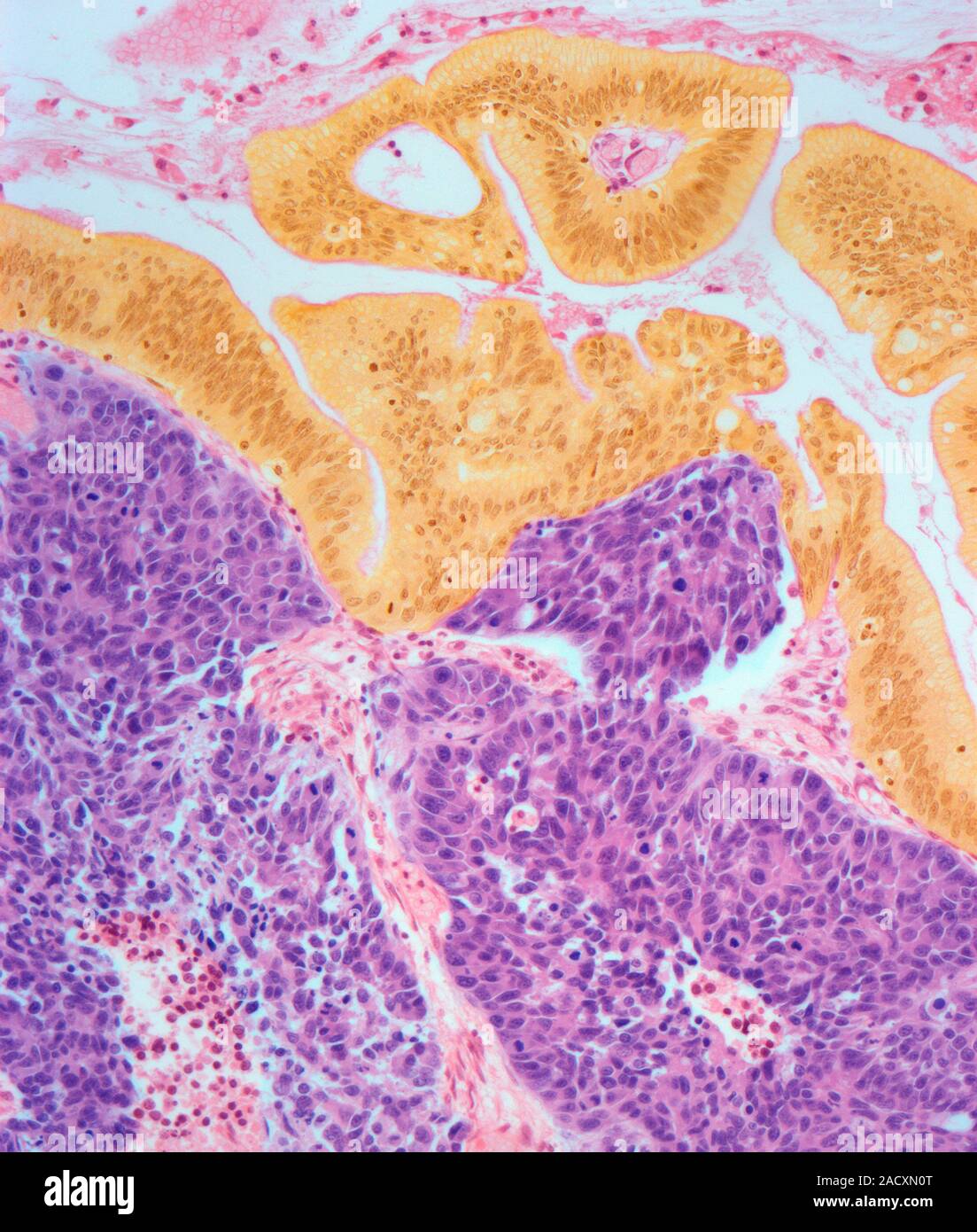 Cervical cancer. Light micrograph (LM) of a section of a large cell