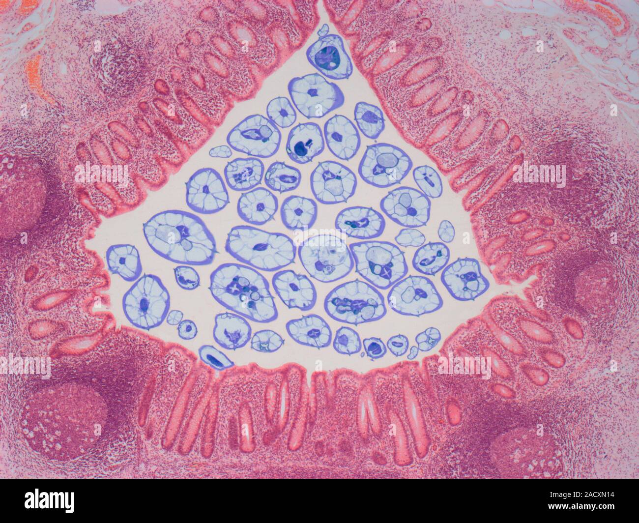 Appendicitis due to threadworm (Enterobius vermicularis) infection