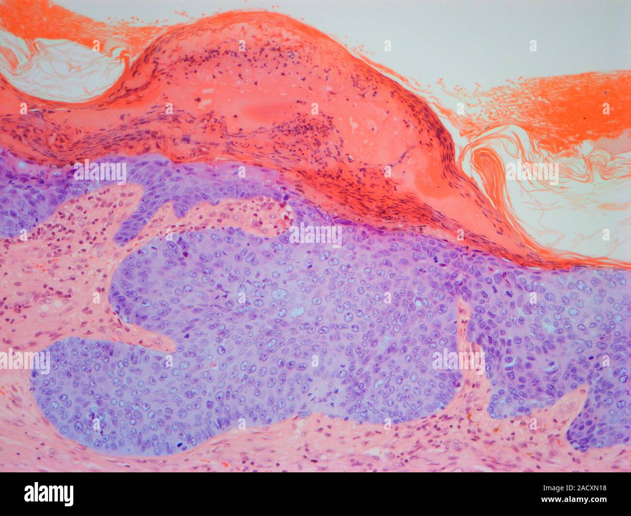 Skin cancer. Light micrograph (LM) of a section of skin showing a pilar ...