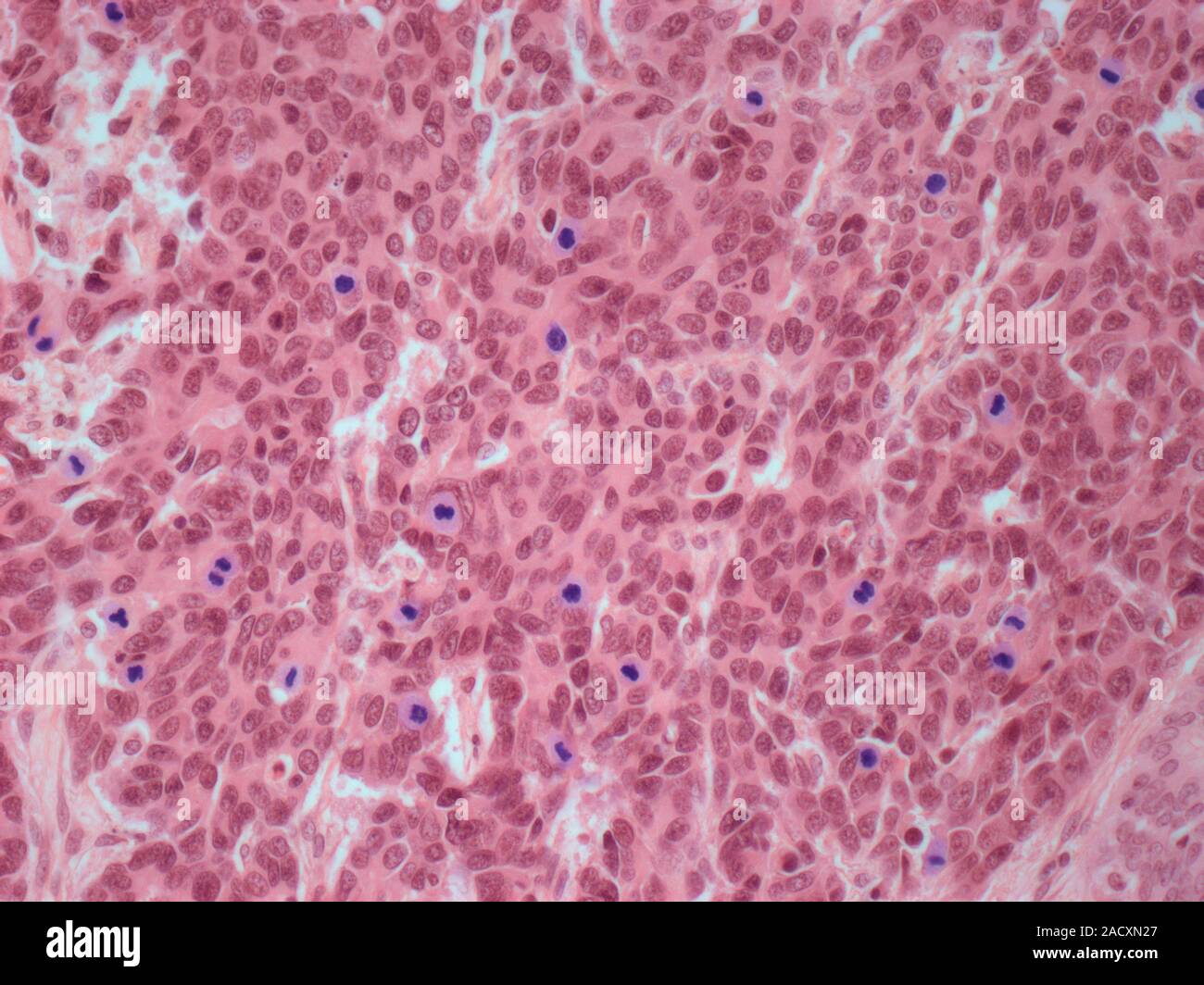 Cervical cancer. Light micrograph (LM) of a section of a large cell