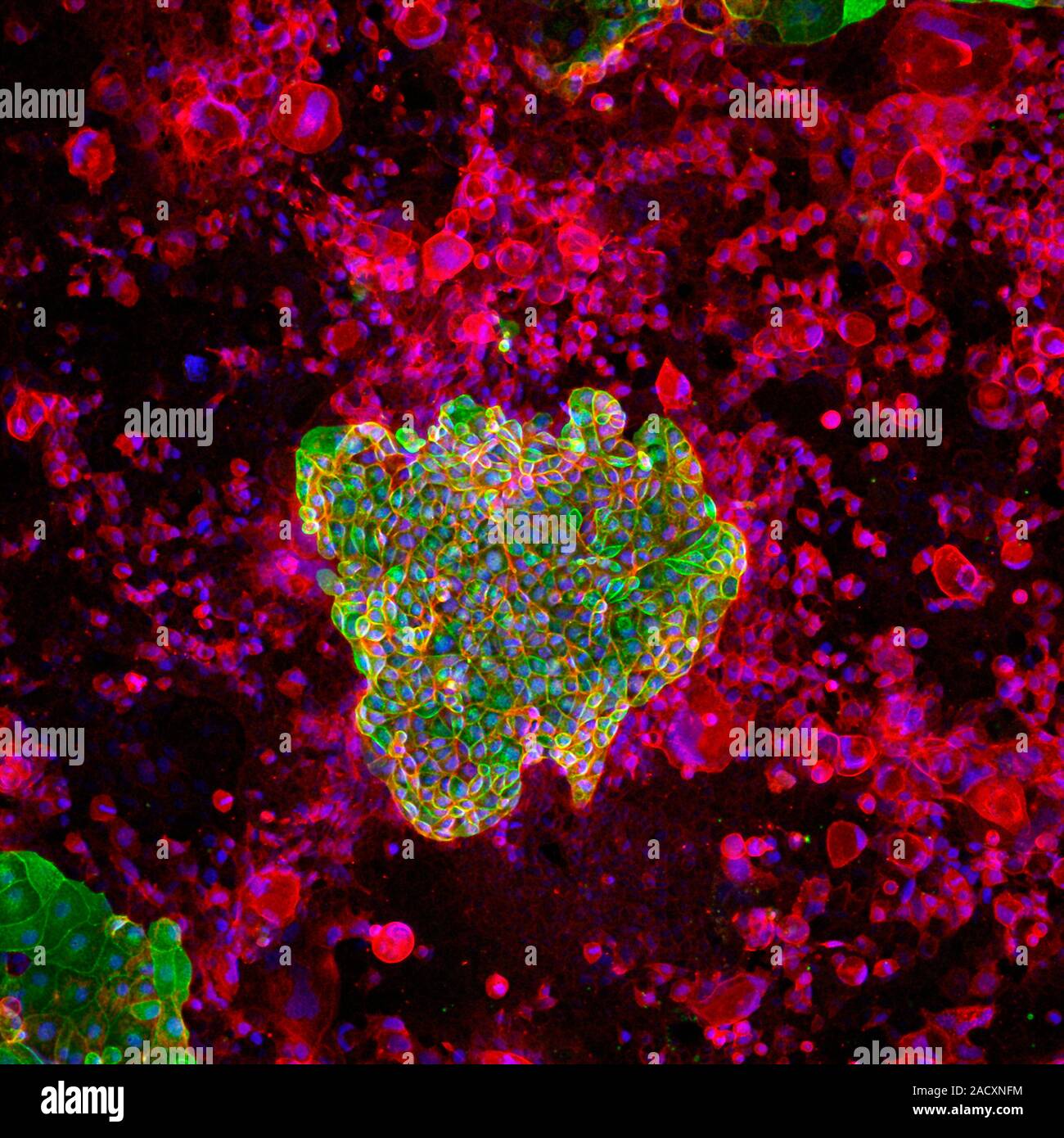 Colon cancer cells. Confocal light micrograph of Caco 2 colon cancer ...